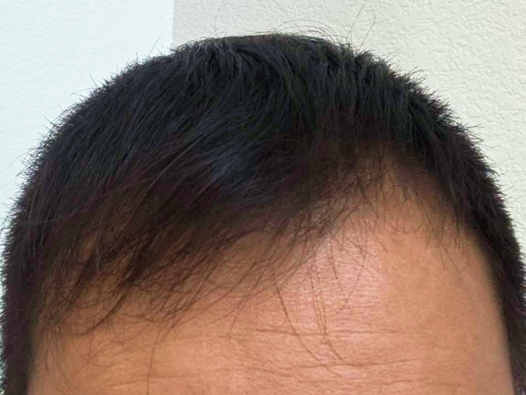 green-cap-hair-after-charlie