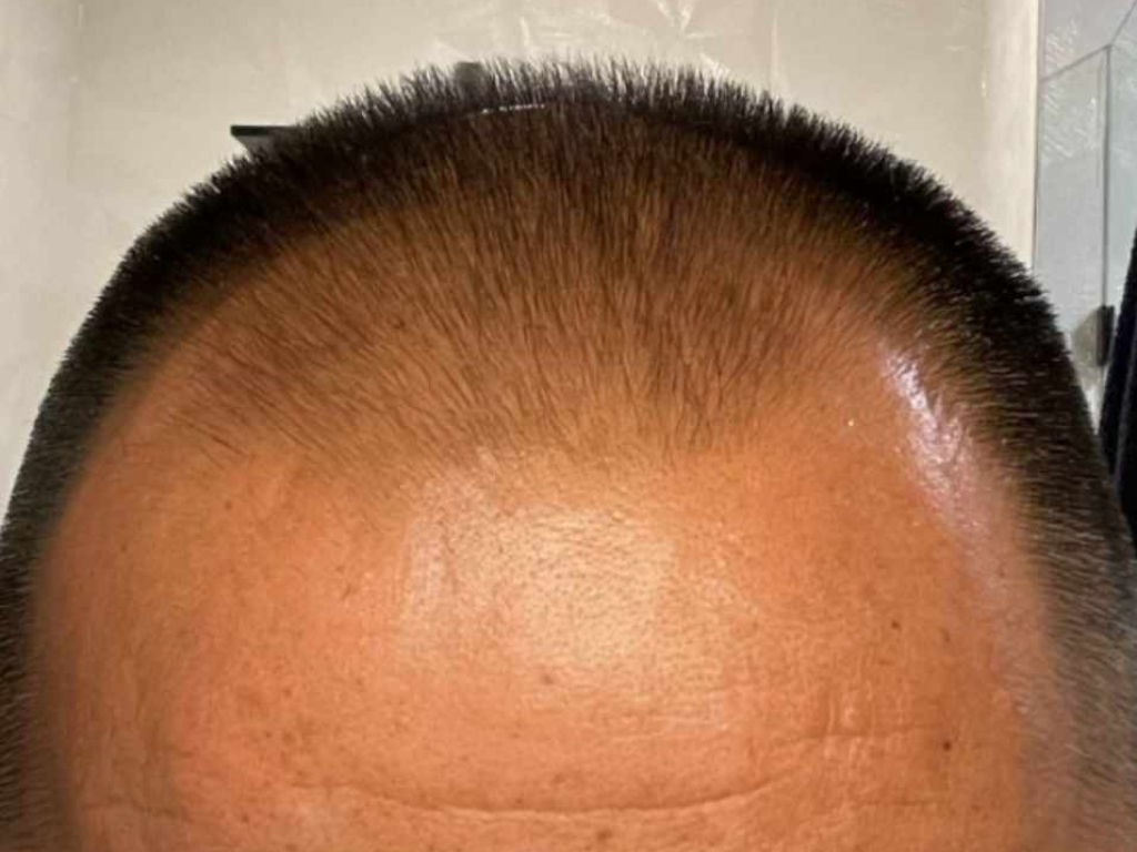 green-cap-hair-after-quiency