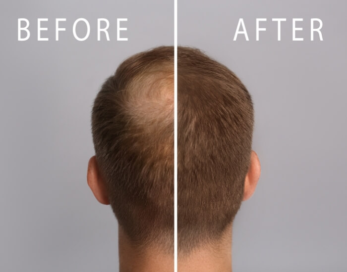 Hair loss treatment in Sugar Land, Texas