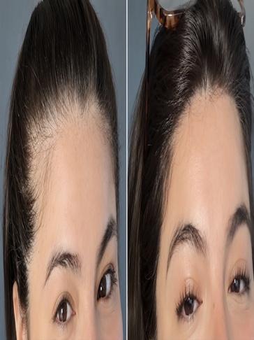 Jenny - hair regrowth progress