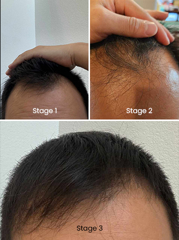 Charlie - hair regrowth progress