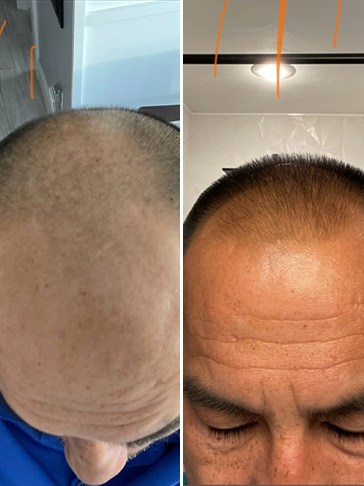 Quincy - hair regrowth progress