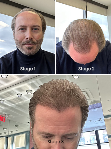 Justin - hair regrowth progress